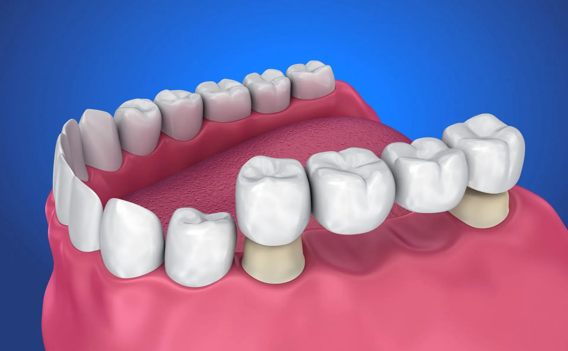 Dental Bridges