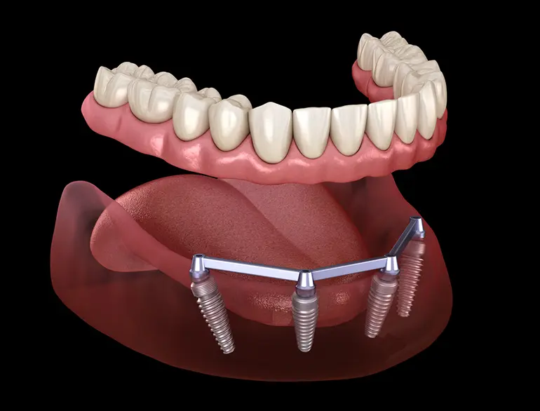 Full Mouth Reconstruction