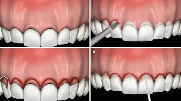 Gum Contouring