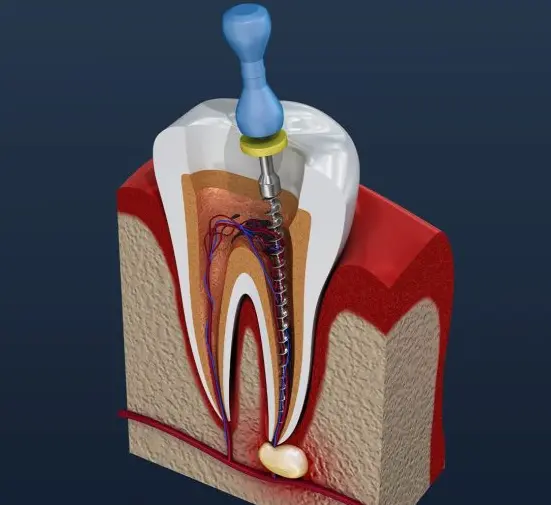 Root Canal Treatment