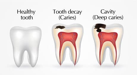 Dental Cavities: Genetics and Other Factors That Affect Oral Health